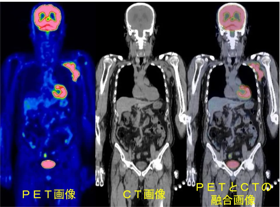 実践! PET-CT診断