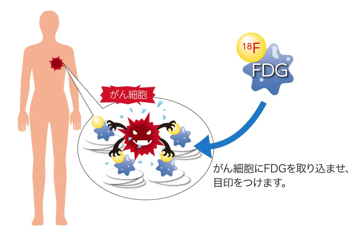 がん細胞にFDGを取り込ませ、目印をつけます。