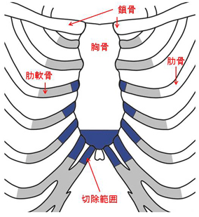 胸肋挙上術変法