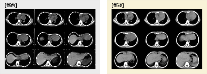 側湾・左右差の改善