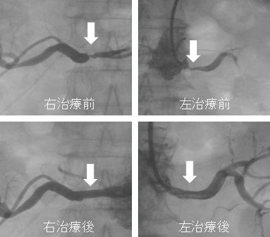 両側腎動脈狭窄の血管内治療前後