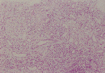 シェーグレン症候群の腎組織像