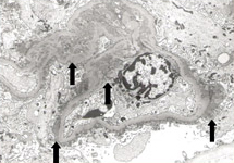 ループス腎炎で見られた免疫複合体の糸球体への広範な沈着写真