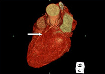 64列MDCTによる冠動脈3DCT画像