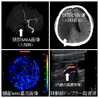 脳梗塞の診断法