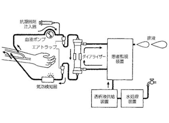 血液透析のしくみ