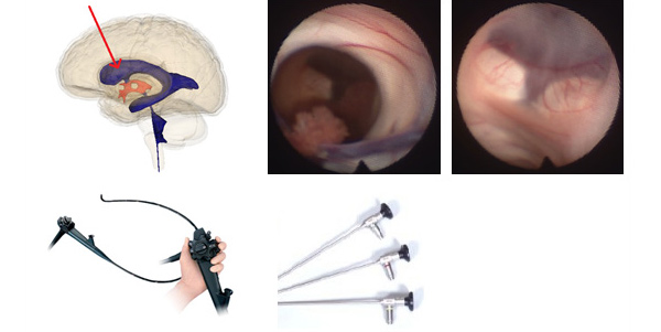 神経内視鏡