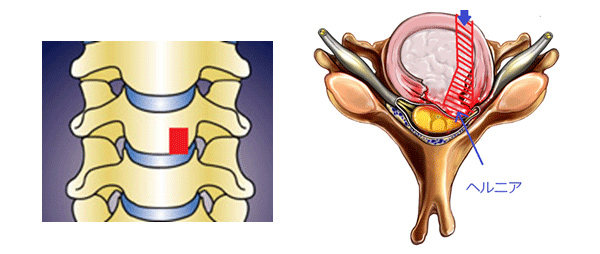 Key hole surgery（鍵穴手術）