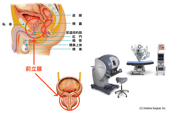 ダヴィンチによる前立腺摘出術