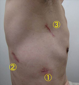  腹腔鏡下手術の創部
