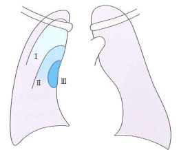 気胸（肺虚脱）の程度