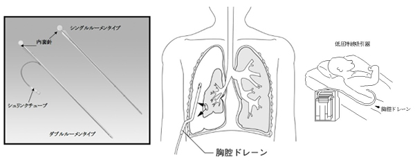 胸腔ドレーン