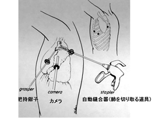 ポート挿入位置