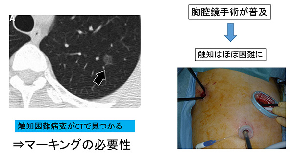 微少肺病変に対する胸腔鏡下精密縮小手術