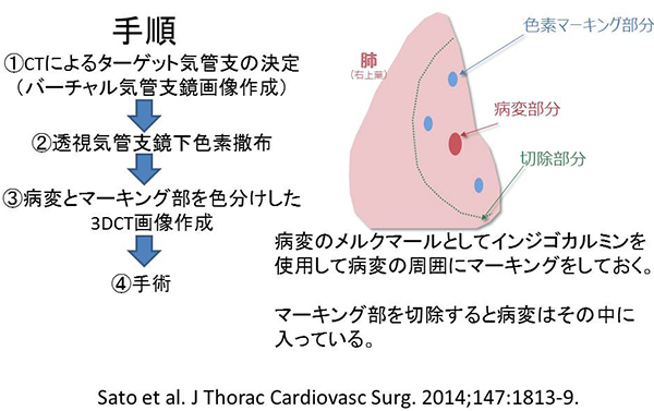 Virtual assisted lung mapping(VAL-MAP)