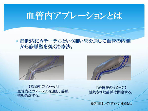 血管内アブレーションとは