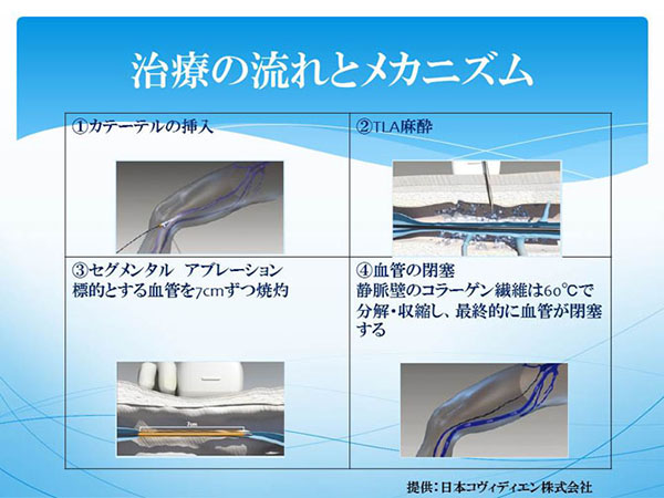 治療の流れとメカニズム