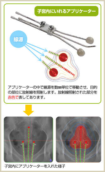 子宮内にアプリケーターを入れた様子