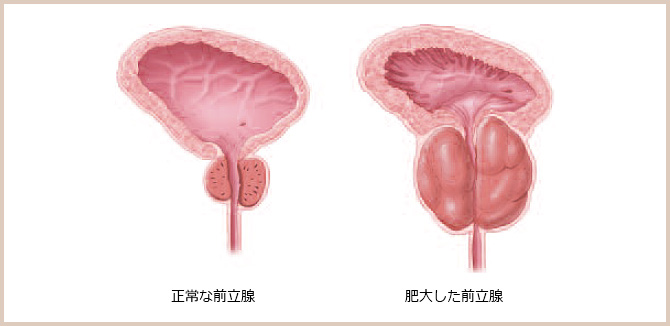 図：肥大した前立腺