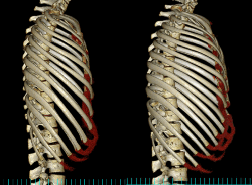 漏斗胸の胸郭側面